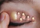 How to Safely Clean Blackheads: A Dermatologist-Approved Guide